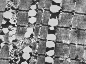 M,61y. | myopathy - steatosis